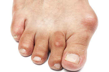 Bunions treatment in the areas of Rochester, NY 14623 and 14616.