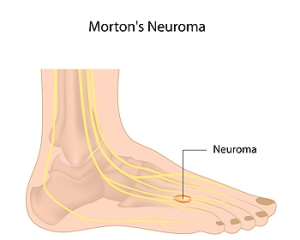 Exercises May Help Morton&rsquo;s Neuroma