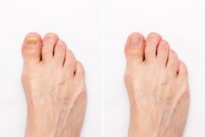 Definition and Risk Factors of Onychomycosis
