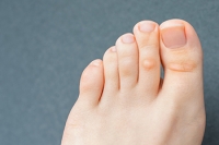 What Can I Do About Corns on My Feet?