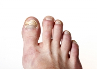 How Does Toenail Fungus Form and How Can You Address It?