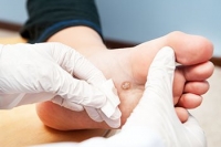 What Does a Foot Wart Look Like?