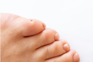 Causes of Foot Corns