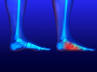Causes of Rigid Flat Feet