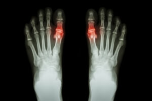Definition and Risk Factors of Gout