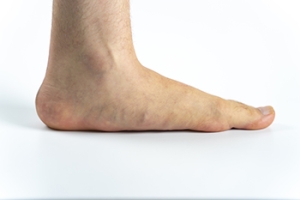Causes and Symptoms of Acquired Adult Flat Feet