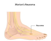Location of Pain From Morton’s Neuroma