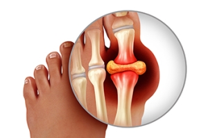 What Causes Gout?