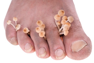 Is Athlete’s Foot Contagious?