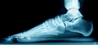 The Consequences of Flat Feet