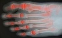 When Rheumatoid Arthritis Affects the Ankles
