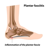 Should I See a Podiatrist, or Care For Plantar Fasciitis at Home?